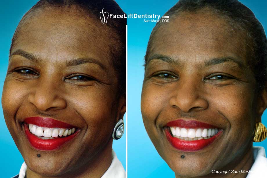  Gap between Front Teeth treated
