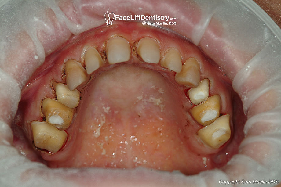 Invasive cosmetic dentistry - Healthy teeth drilled down for porcelain crowns