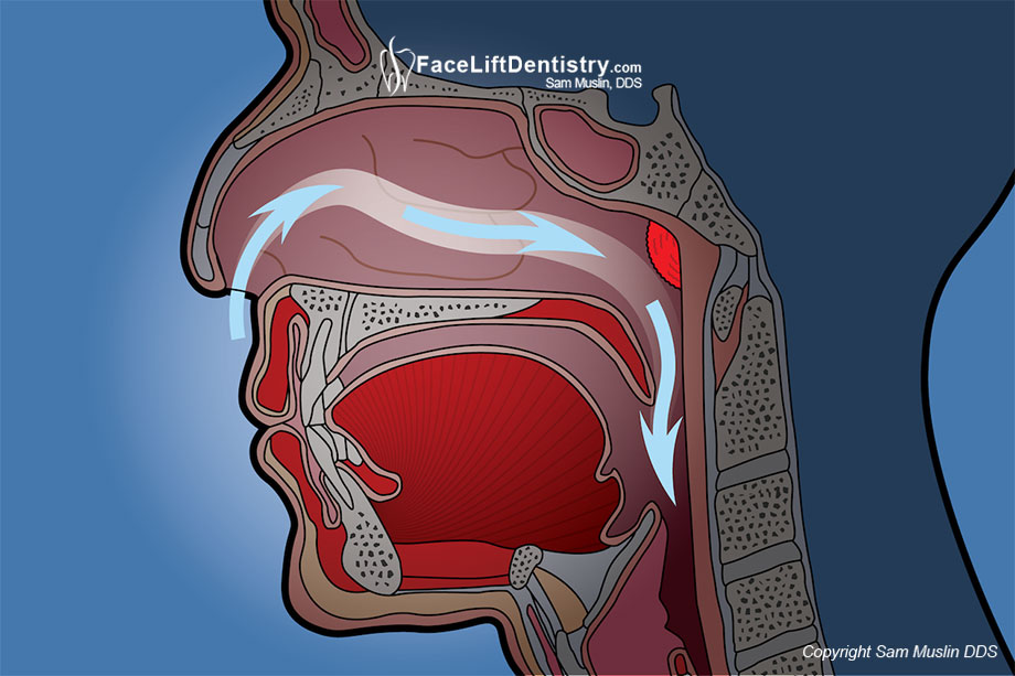 Illustration showing a normal jaw position and unobstructed airway passage