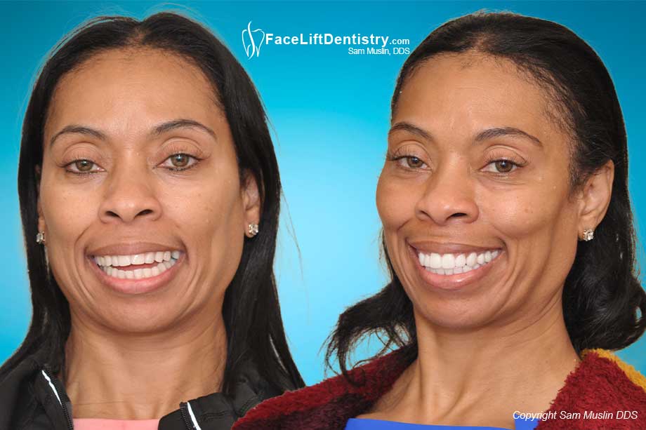 Before and after photo showing a patient with an open-bite, corrected in the after without surgery or braces