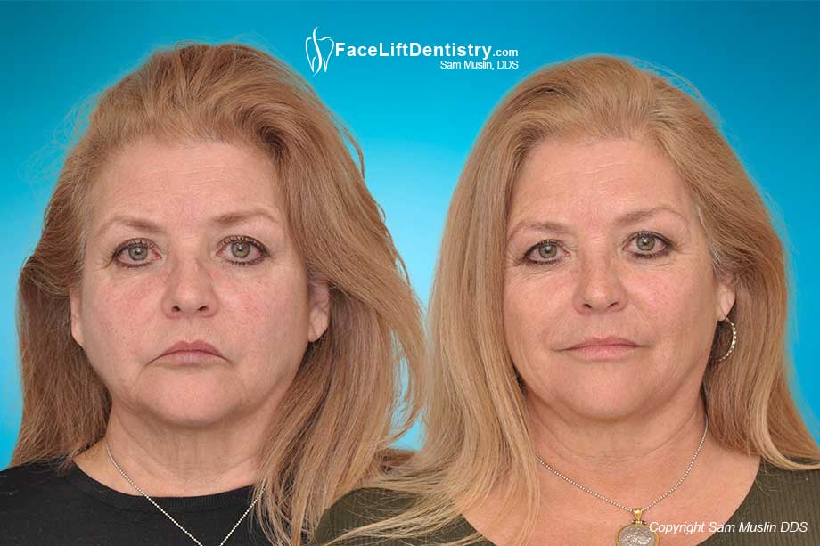 The photo on the left shows worn yellow crooked teeth and an overbite. In the after photo on the right the entire face shows the outcome of treating her bite with Face Lift Dentistry®.