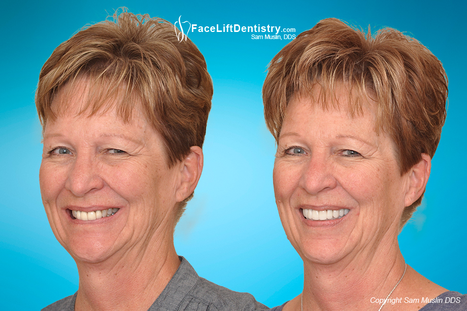 Signs of aging removed after the jaw alligned to the ideal position - before and after photos
