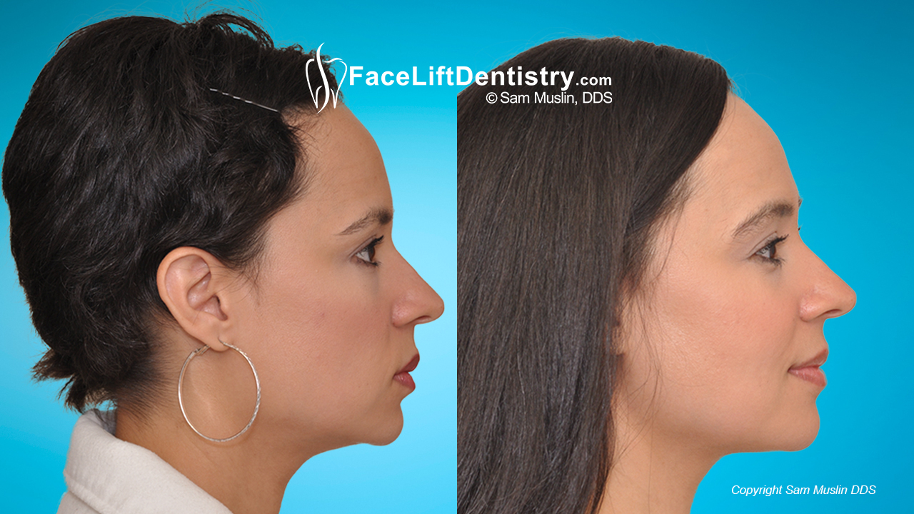 facial profile correction, before and after treatment with facelift dentistry