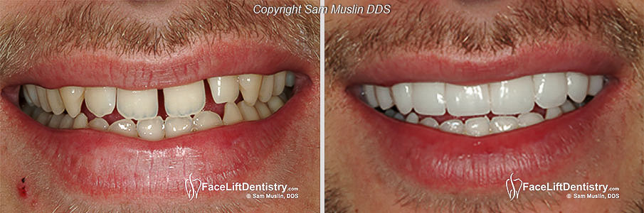  The before and after picture shows "instant braces" resulting in straight teeth and no gaps between teeth.