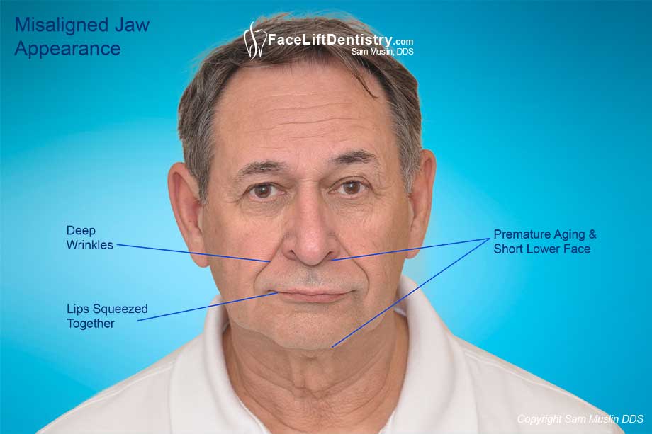 Misaligned Jaw Problems