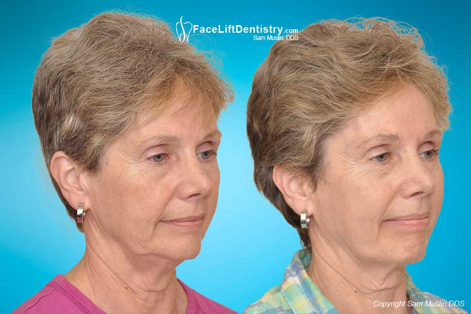 Jaw Popping and Clicking treated with TMJ Bite Correction - Before and After