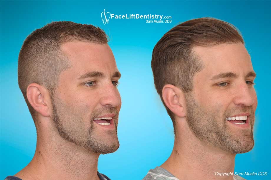 Before and after jaw alignment and bite correction.