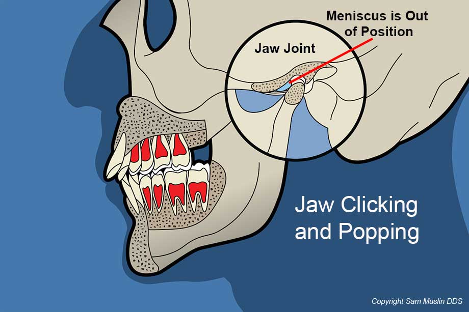 Jaw Clicking and Popping Illustration