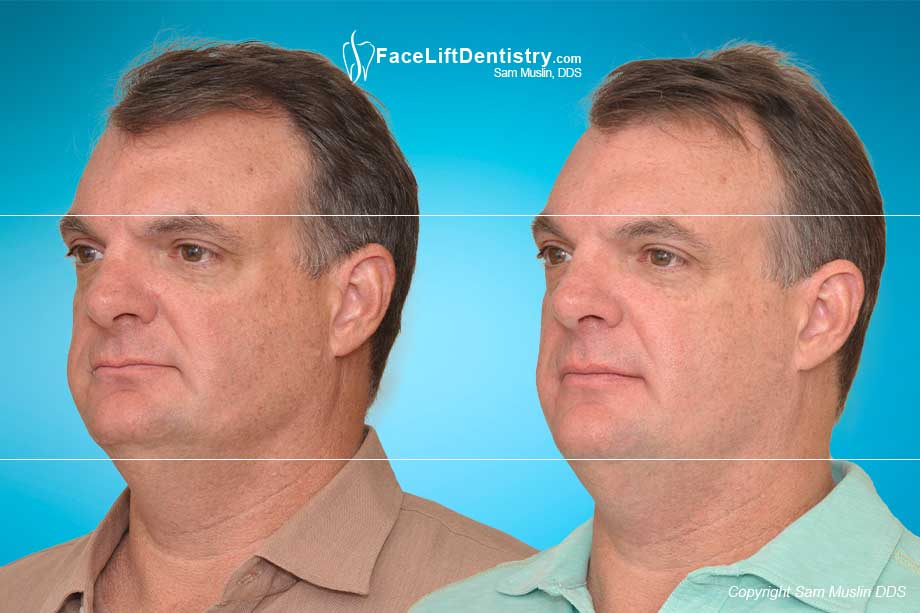 Jaw repositioned with JawTrac® and over bite Corrected - Before and After Photo