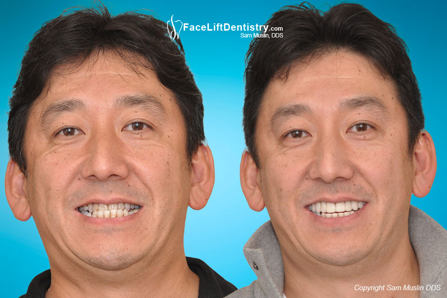 The correct jaw position visibly reduces jaw stress - before and after