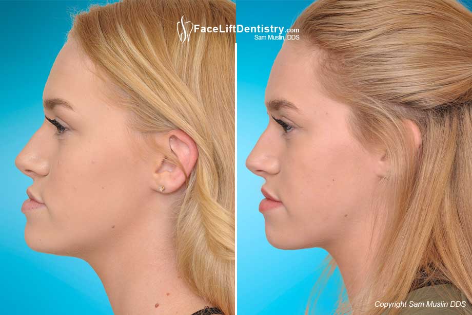 Realigning the jaw corrected her underbite and improved her chin size without surgery - before and after photo