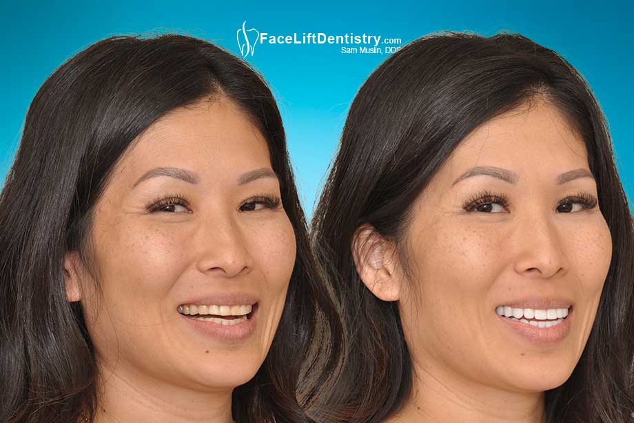 Jaw realignment without surgery to the ideal jaw position - before and after photo.