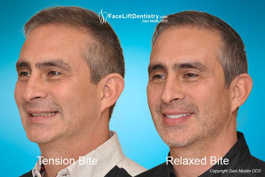 Jaw tension treated - before and after