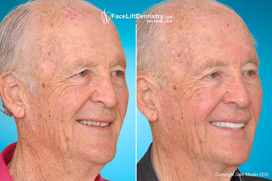 Overbites cause the nose and chin to stick out - Before and After Treatment