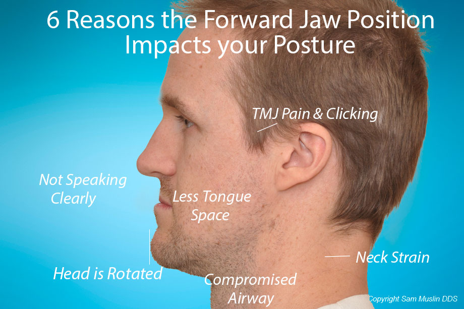 Patient with an underbite with symptoms and impact on his posture highlighted