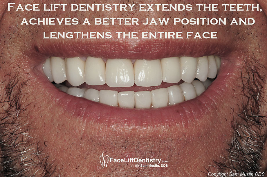 Reconstructing Teeth