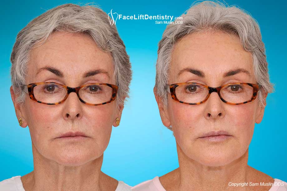 Short teeth cause a drooping mouth and visible aging. In the after photo this has been corrected showing the anti-aging benefit.