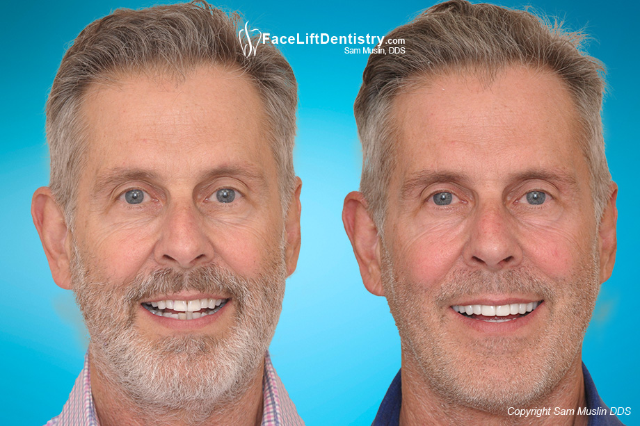 Anti-Aging benefits after jaw repositioning