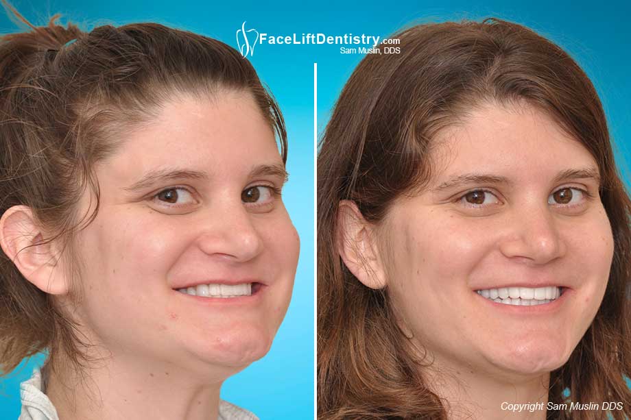 Braces failed to correct her class 3 malocclusion. The answer is VENLAY Restorations.