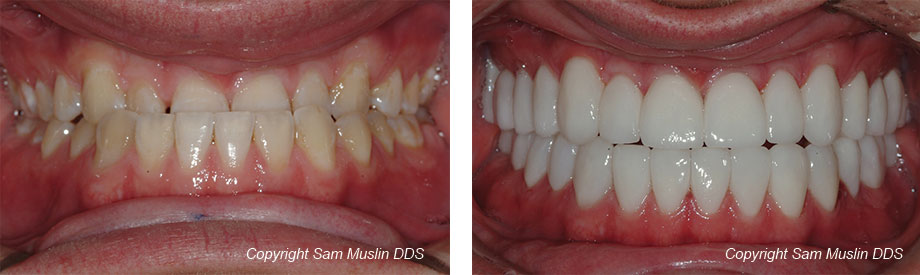 Close-up photo showing mandibular prognathism before and after treatment.