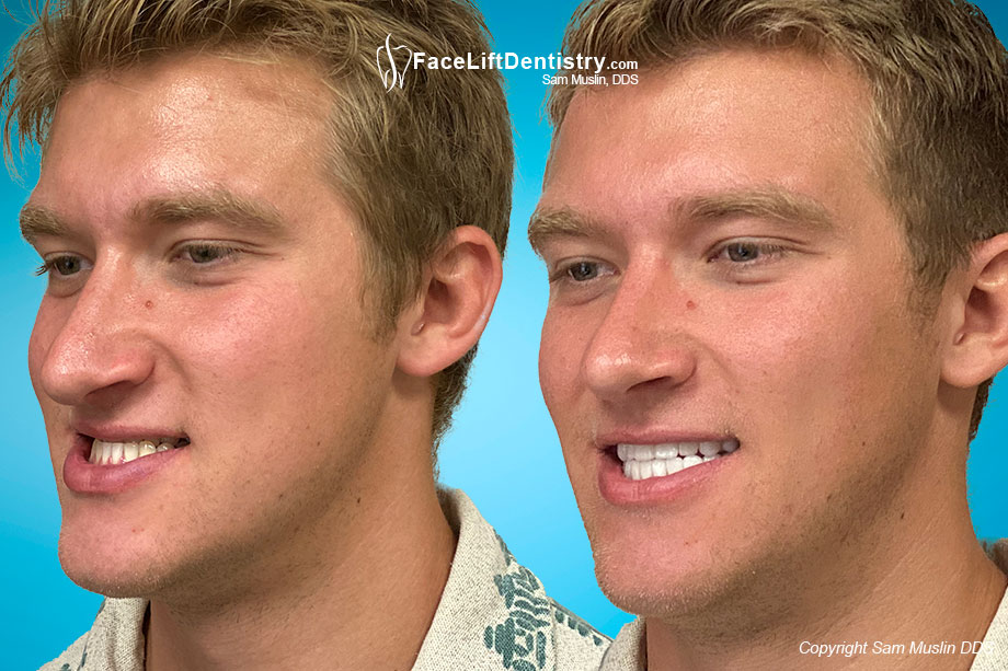 No Surgery and No Braces alternative treatment for Mandibular Prognathism, Before and After Photo