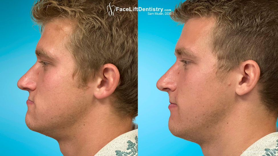 Mandibular Prognathism Facial Profile - Before and After