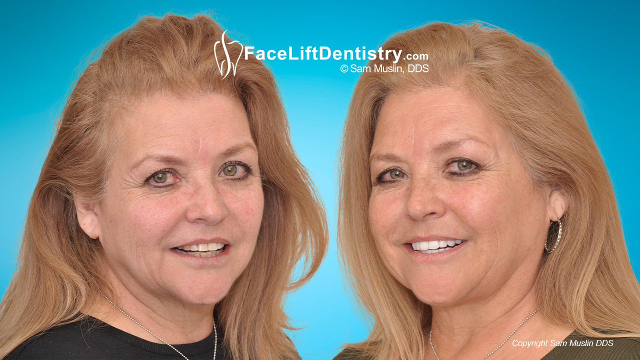 facial profile correction, before and after treatment with facelift dentistry
