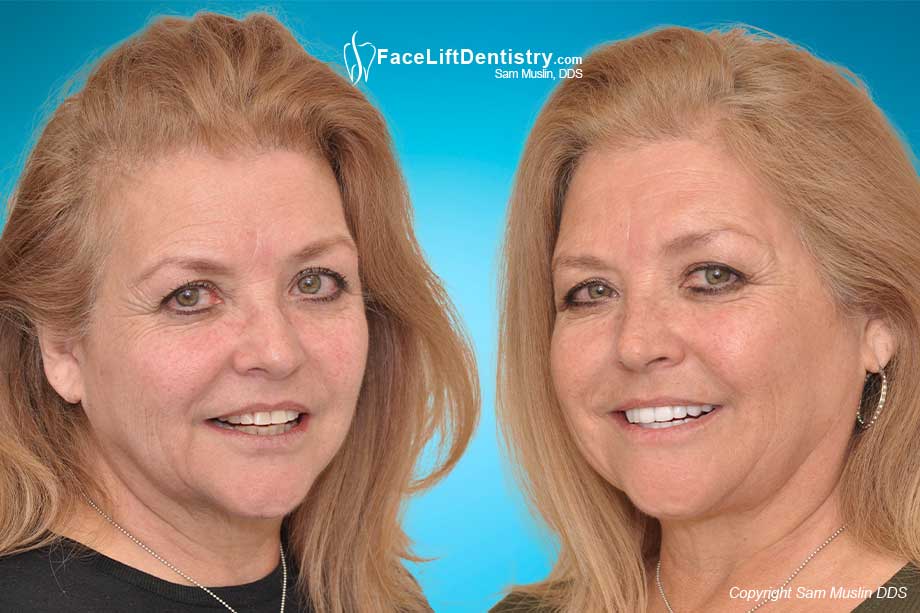 The photo on the left shows worn yellow crooked teeth and an overbite. In the after photo on the right the entire face shows the outcome of treating her bite with Face Lift Dentistry®.