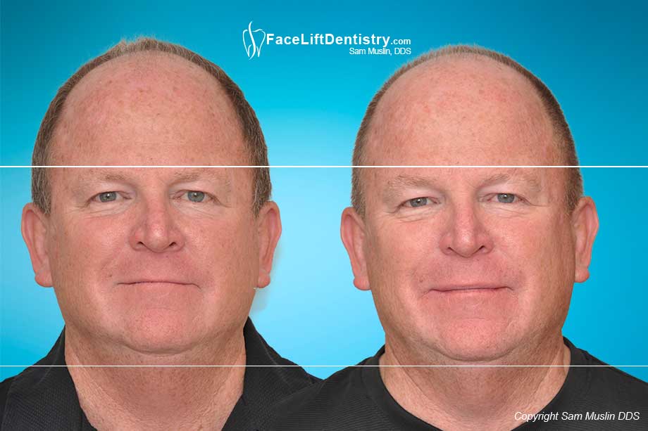 Can't see my upper teeth!