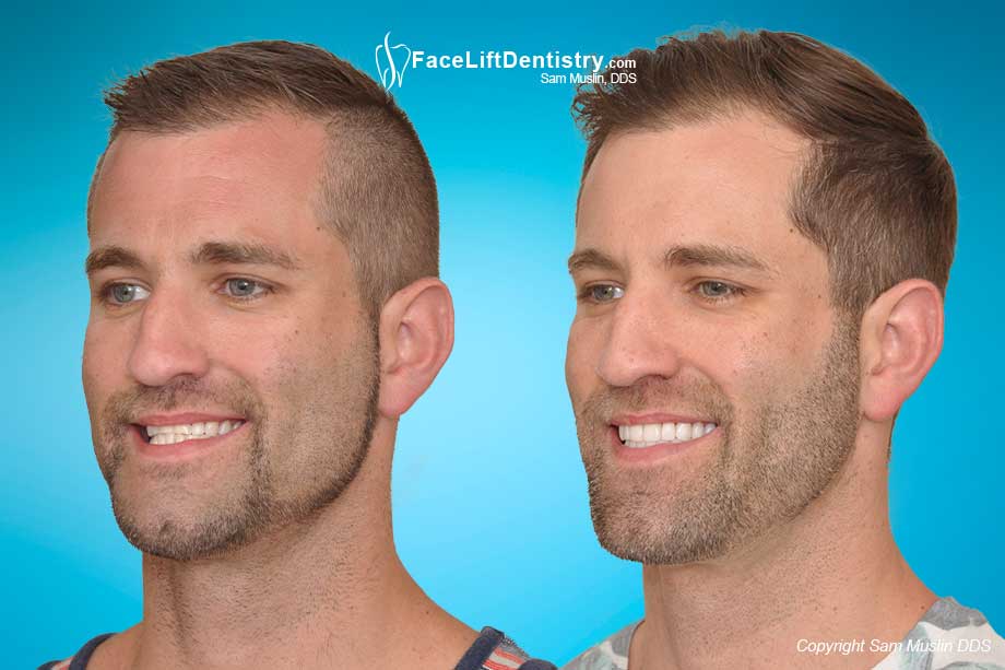 A misaligned jaw due to an overbite, even with straight teeth.