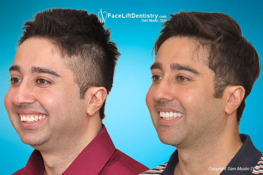 Reposition the Jaw to Improve the Airway