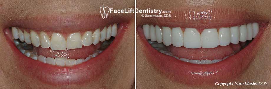 jaw crooked fix before tmj surgery pain misaligned correction bite headaches drilling left