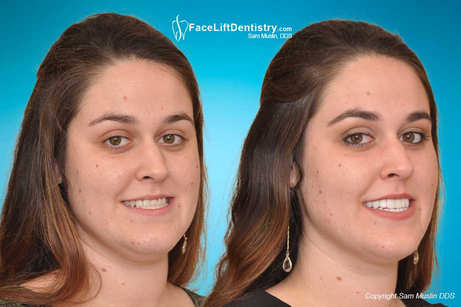 Jaw Surgery and Braces Avoided