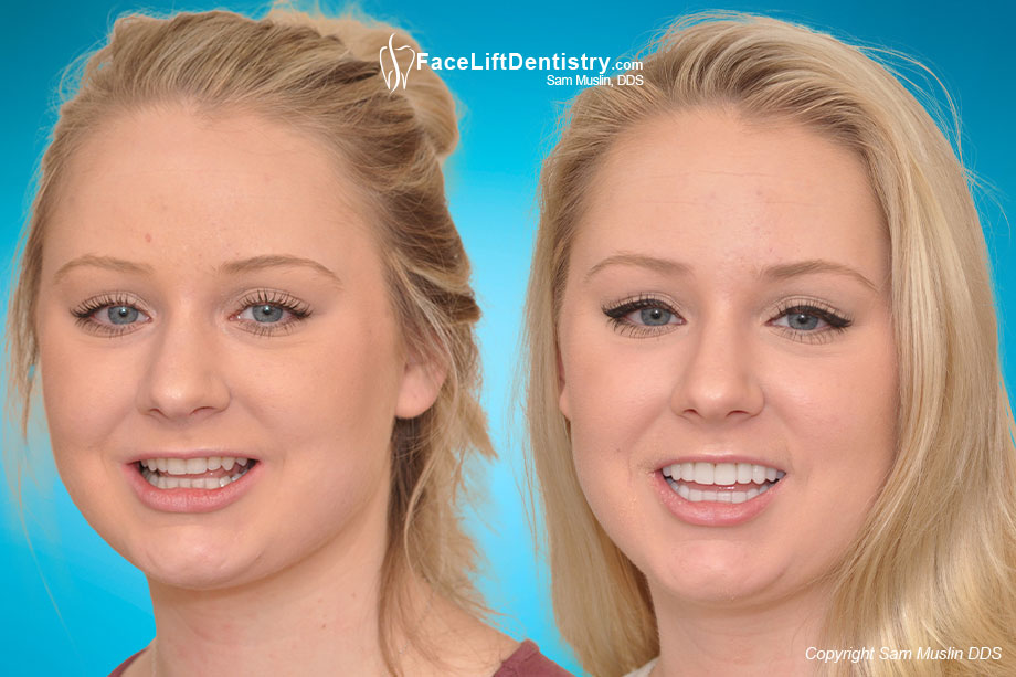  The photo on the left shows worn yellow crooked teeth and an overbite. In the after photo on the right the entire face shows the outcome of treating her bite with Face Lift Dentistry®.