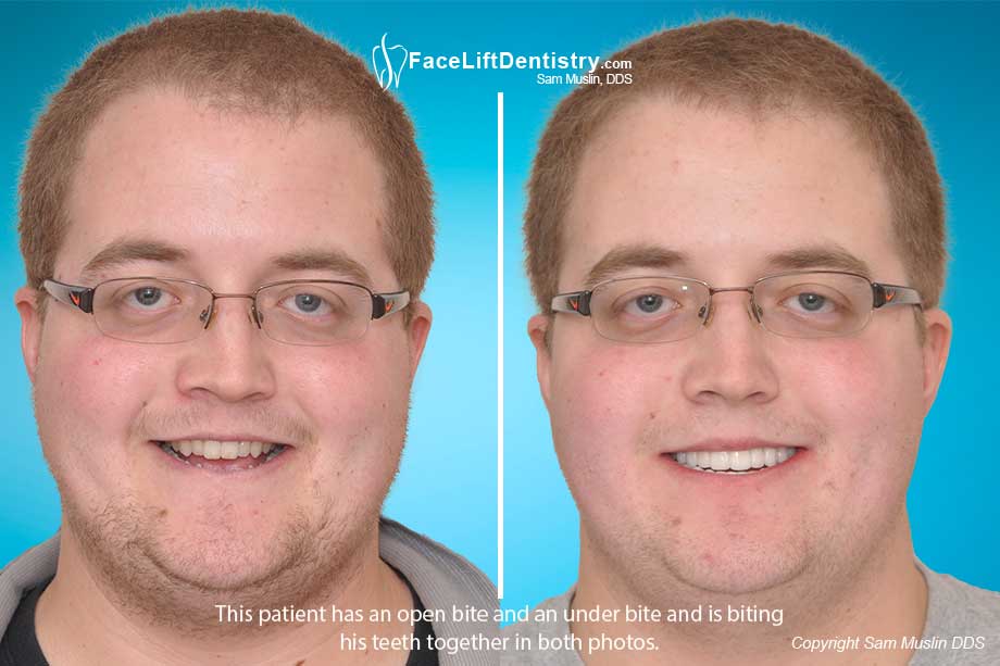 Open bite and underbite corrected without surgery or invasive dentistry. 