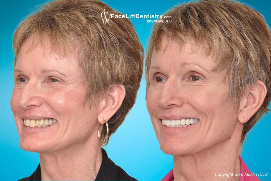  The photo on the left shows worn yellow crooked teeth and an overbite. In the after photo on the right the entire face shows the outcome of treating her bite with Face Lift Dentistry<sup>®</sup>.