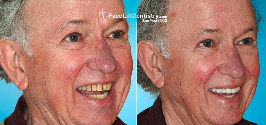 A senior patient smiles before and after non-invasive porcelain veneers were bonded to his teeth. 