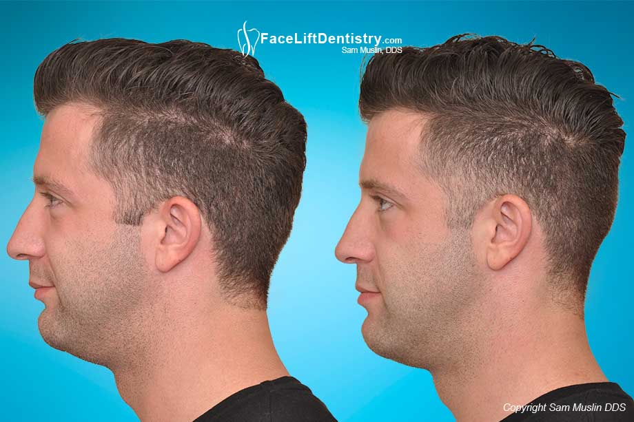 Overbite and Recessed Chin Corrected