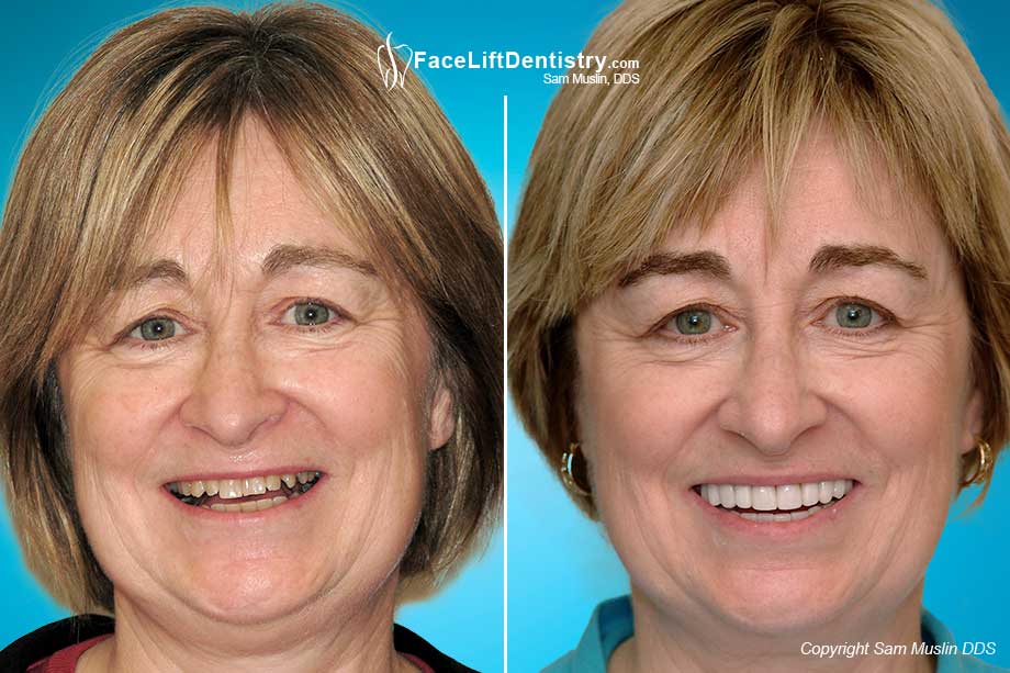  Before and After of a patient treated with the Non-Surgical Face Lift