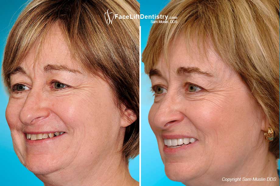  Non-surgical Face Lift Treatment - Before and After Photos