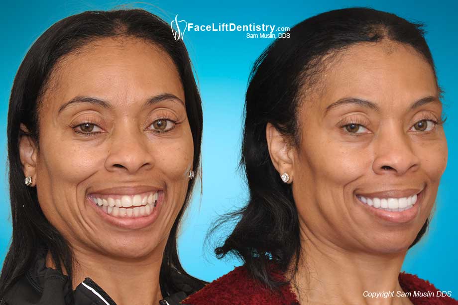  Non-surgical open-bite fix, before and after