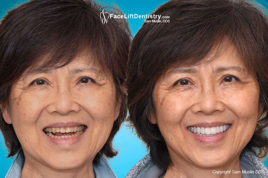 A patient with an anterior openbite, before and after treatment.