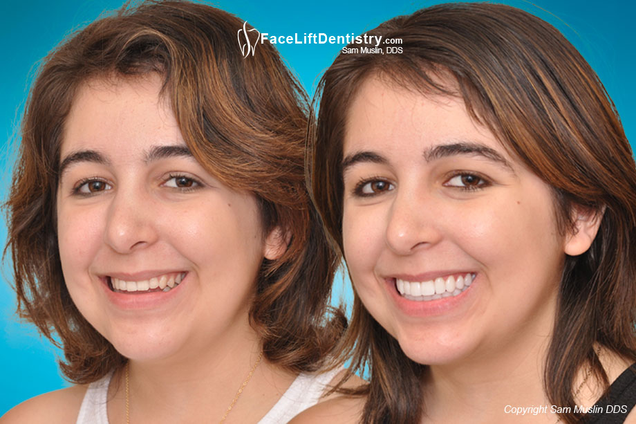 Before and After Open Bite Correction and a Natural JAw Position