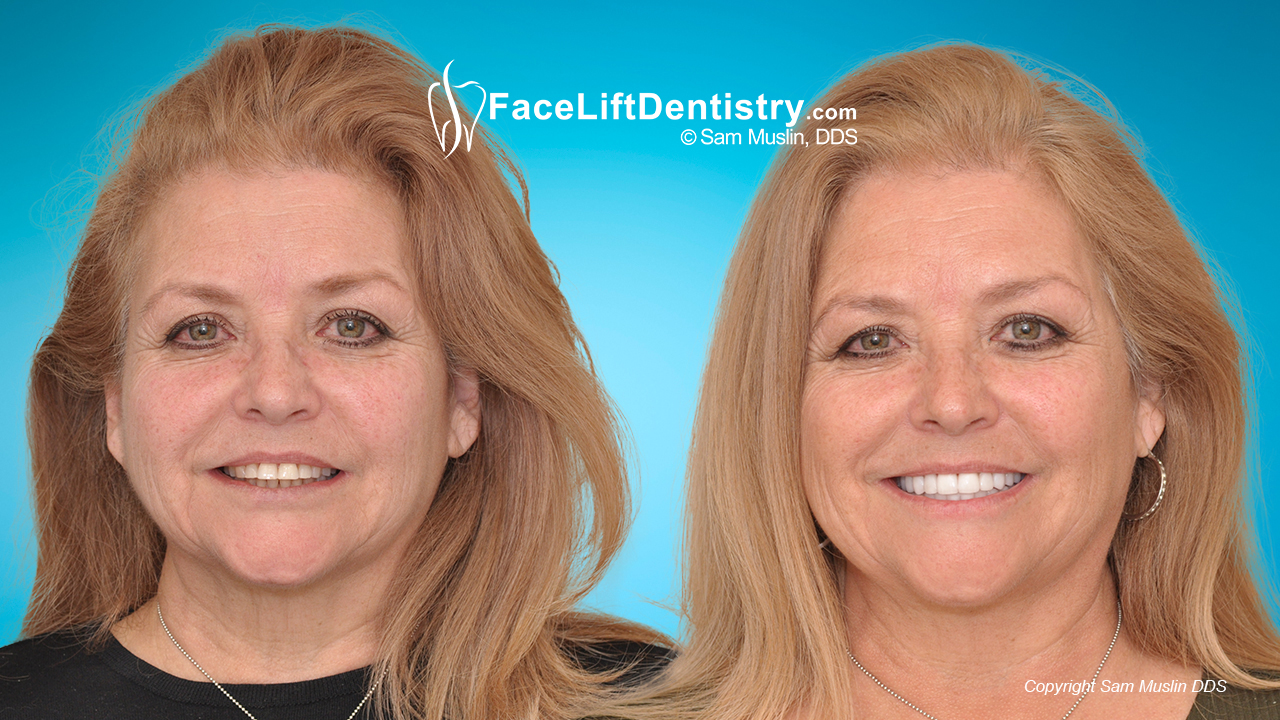 small teeth and overbite corrected for a better profile, before and after