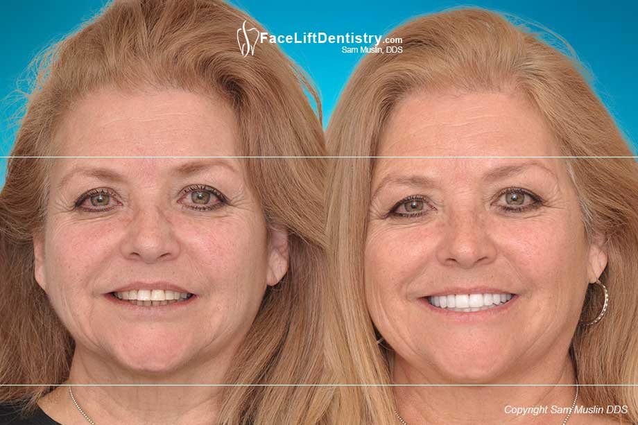 The photo on the left shows worn yellow crooked teeth and an overbite. In the after photo on the right the entire face shows the outcome of treating her bite with Face Lift Dentistry®.