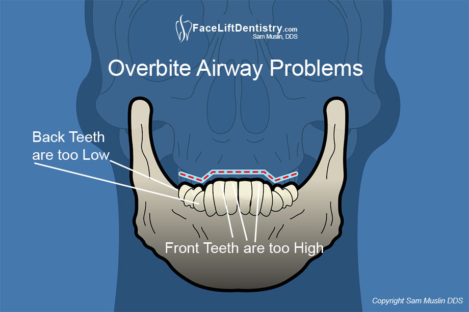 Illustration showing how an overbite can impact the airway