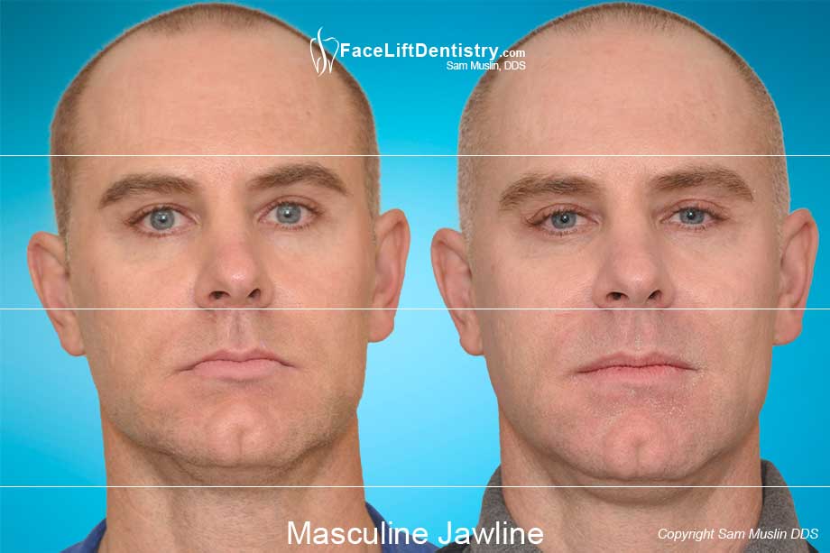 Patient showing corrected overbite and a masculine jawline, without surgery or braces - before and after photo