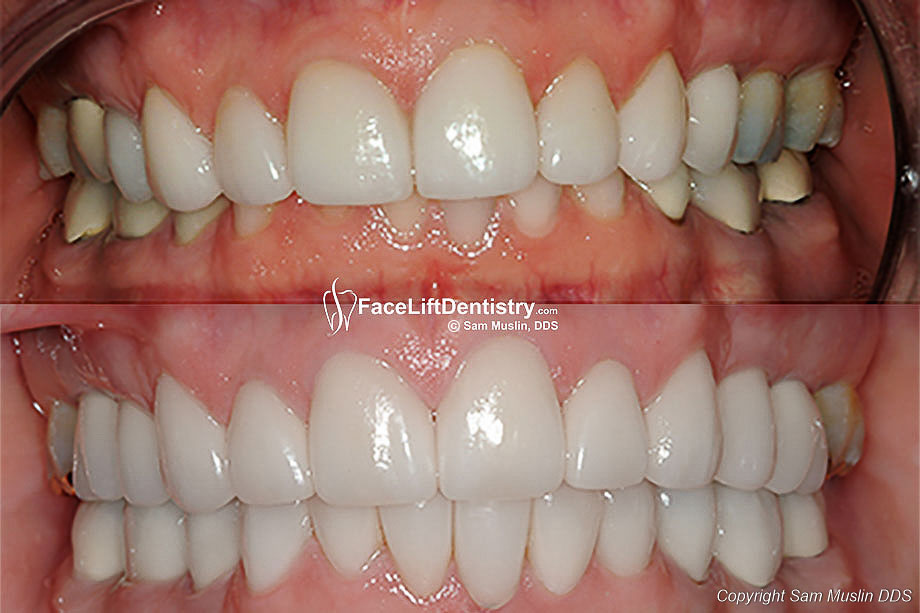 Top photo shows failed veneers and an worsened overbite. Bottom photo shows VENLAY<sup>®</sup> Restorations which replaced the veneers and fixed the overbite.