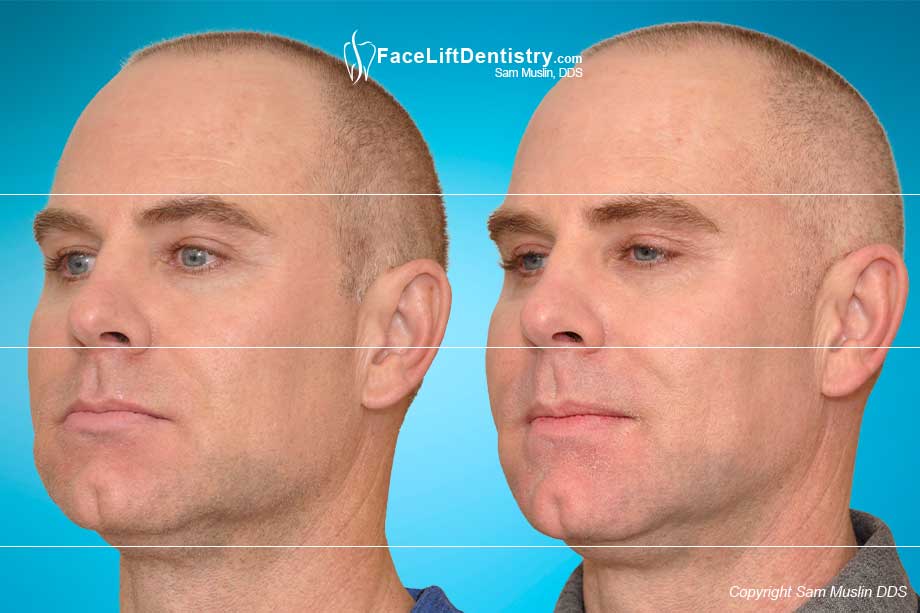Braces could not fix his overbite in the before photo. The after photo shows correction with VENLAY® Restorations.