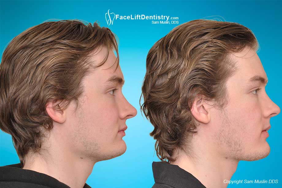 Jaw and chin surgery alternative to correct a weak chin and overbite - Before and After Photo